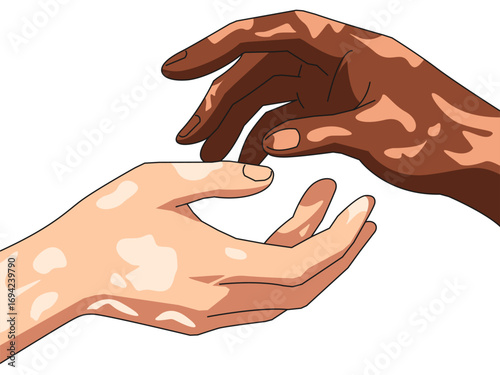 Portrait hands of vitiligo sufferers with different skin tones. Unique skin pigmentation highlighting natural beauty. World vitiligo day. Skin depigmentation, skin disorder.