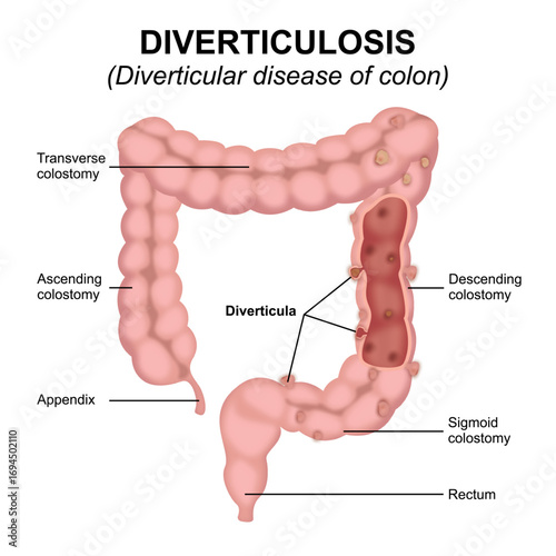 Diverticulosis - Diverticular disease of colon
