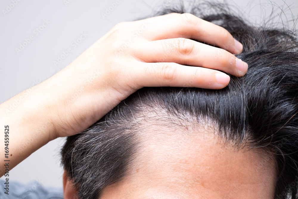 Fototapeta premium 薄毛を気にする男性（M字に後退する額）