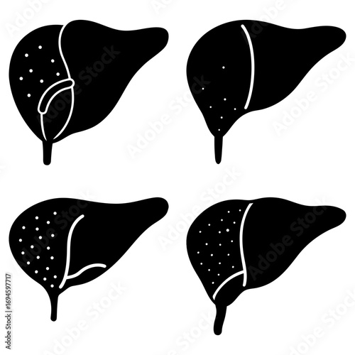 Four liver illustrations showing different stages of disease in black and white detailed drawing style