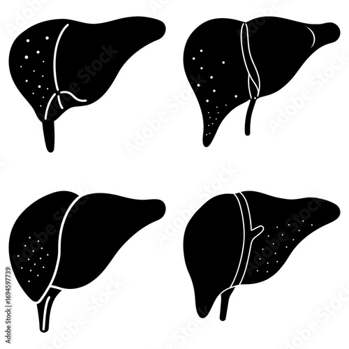 Four liver illustrations showing various liver conditions in black and white medical diagram style art