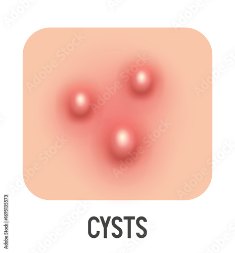 Cysts vector illustration. Acne type. Vector 3d clipart