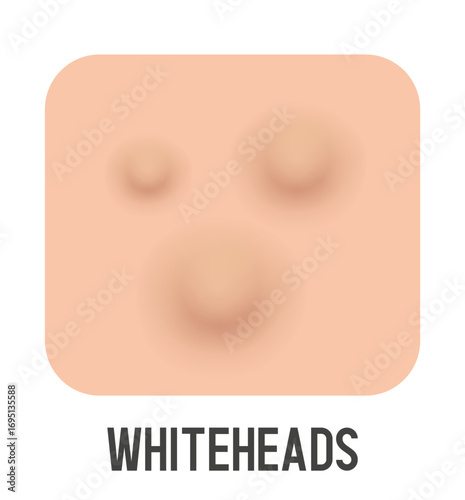 Closed comedone vector illustration. Acne type. Vector 3d clipart
