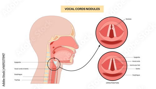 Vocal cord nodules