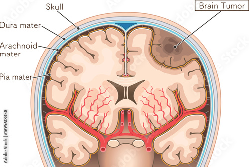 脳腫瘍のイラスト Brain tumor illustration