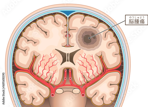 脳腫瘍のイラスト Brain tumor illustration
