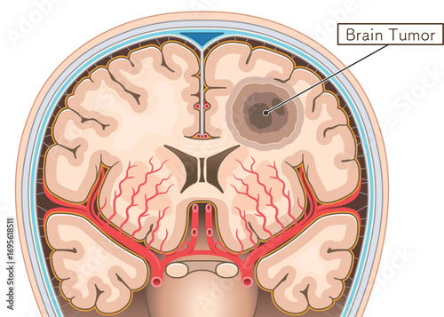 脳腫瘍のイラスト Brain tumor illustration