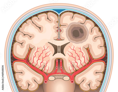 脳腫瘍のイラスト Brain tumor illustration