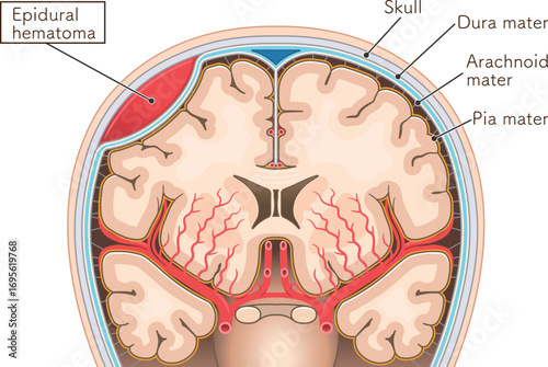 硬膜外血腫のイラストIllustration of an epidural hematoma