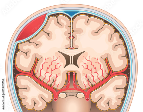 硬膜外血腫のイラストIllustration of an epidural hematoma