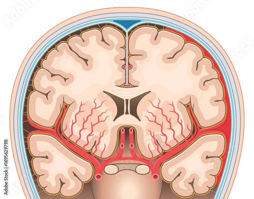 くも膜下出血のイラスト Illustration of subarachnoid hemorrhage
