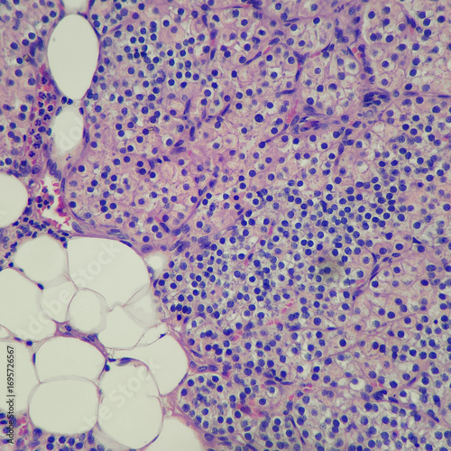 Camera photo of benign parathyroid tissue, consisting of chief and oxyphil cells, magnification 400x, photograph through a microscope