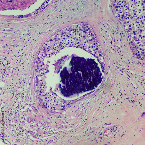 Camera photo of ductal carcinoma in situ (DCIS) with comedonecrosis pattern, containing calcification, magnification 200x, photograph through a microscope