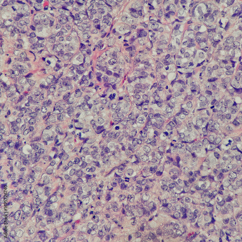 Camera photo of carcinoma, showing atypical mitosis at the center of the picture, magnification 400x, photograph through a microscope