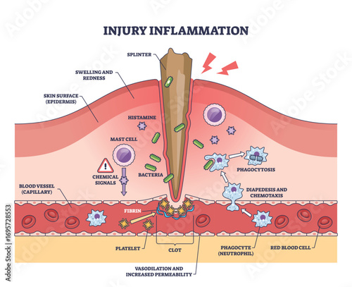 Injury inflammation shows a splinter penetrating skin, with bacteria, immune cells, and chemical signals depicted. Outline diagram