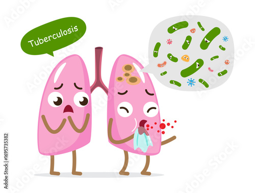 Pulmonary tuberculosis . TB lung cartoon character . Mycobacterium tuberculosis bacteria infected in apex of left lung . Isolated white background . Vector .