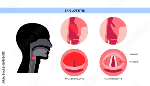 Epiglottitis medical poster