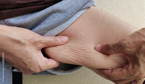 portrait the fingers holding the flabbiness adipose sagging skin, wrinkles and scar, Flabby skin and loose on the leg, health care and beauty concept.