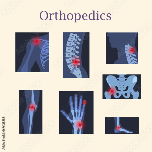 X-ray images of typical orthopedic injuries of the acromioclavicular joint, lumbar spine, cervical spine, hip joint, knee joint, finger phalanx, wrist joint, ankle joint on a cream background
