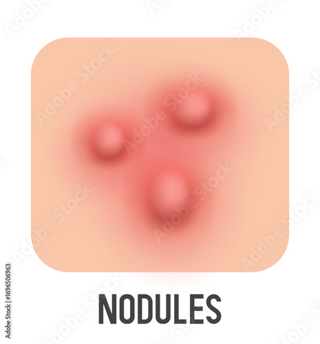 Nodules vector illustration. Acne type. Vector 3d clipart