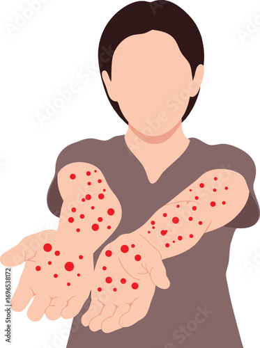Medical Illustration of Severe Skin Rash with Red Spots on Both Arms – Symptoms of Allergic Reaction, Infection, or Skin Disease