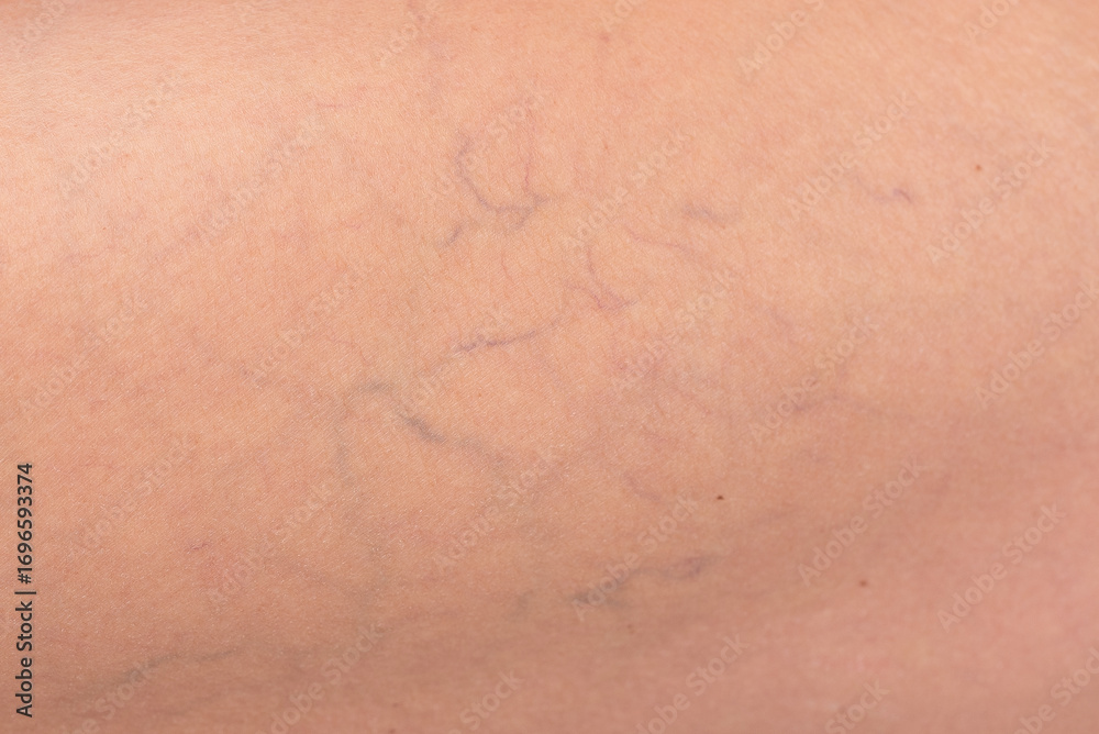 Fototapeta premium Macro photo showing varicose veins and capillaries on a woman’s skin. Close-up detail of vascular issues for dermatology, medicine, and aging body care concepts.