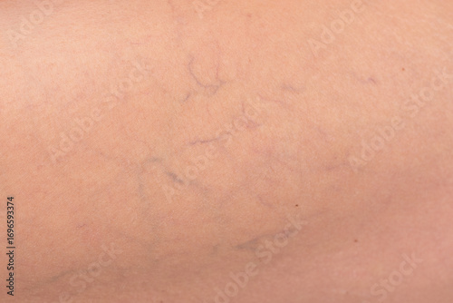 Bild auf Leinwand Macro photo showing varicose veins and capillaries on a woman’s skin