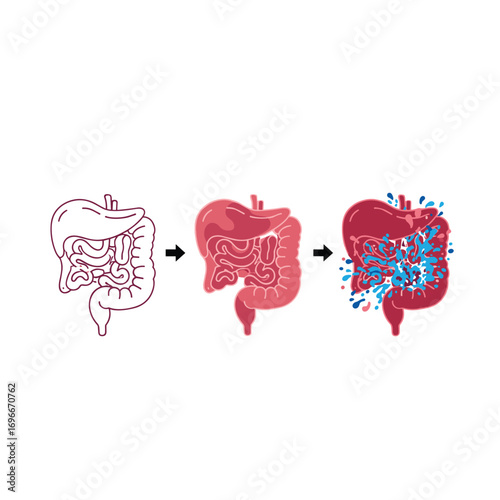 Visualizing the transformation of a healthy digestive system into an inflamed diseased organ