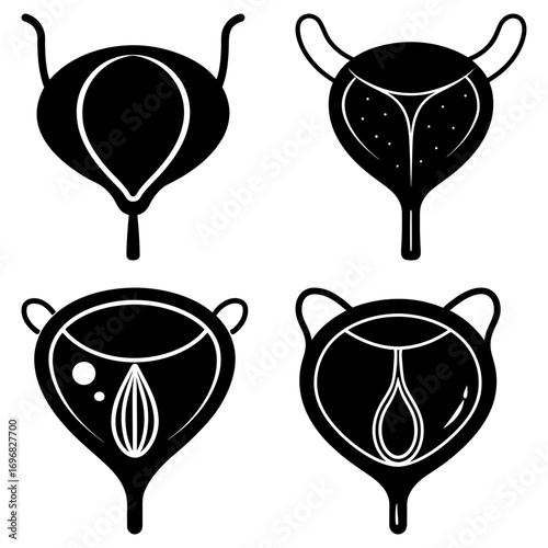 Illustration showing various bladder conditions and anatomical variations in black and white style drawing