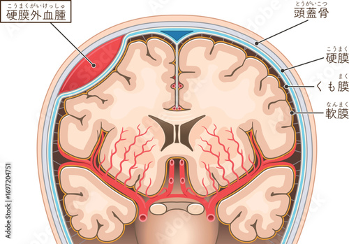 硬膜外血腫のイラストIllustration of an epidural hematoma
