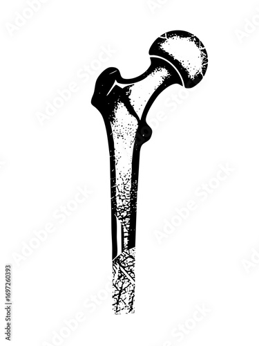 Vector Detailed of a fractured human femur bone.