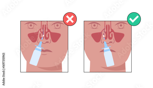 Proper nasal spray usage