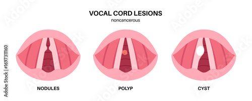 Vocal cord lesions