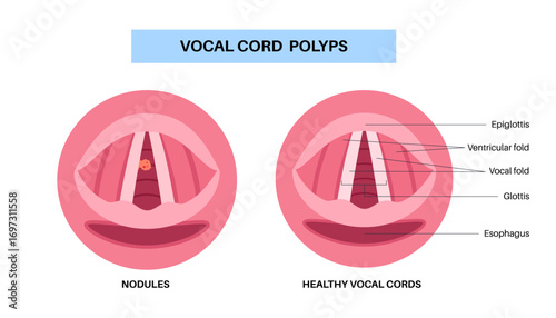 Vocal cord polyps