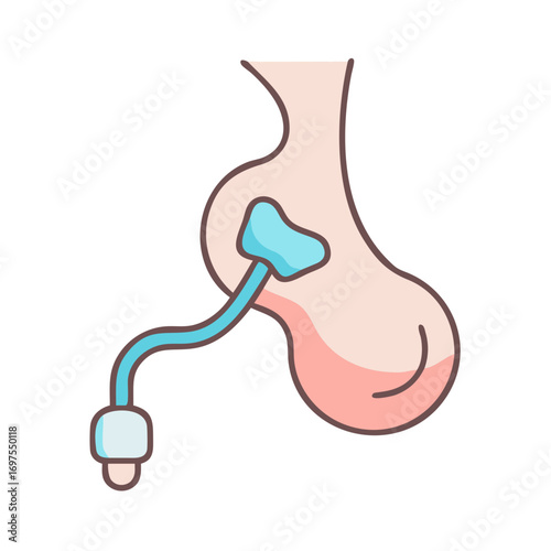 Illustration of hydrocele condition with catheter in cartoon style