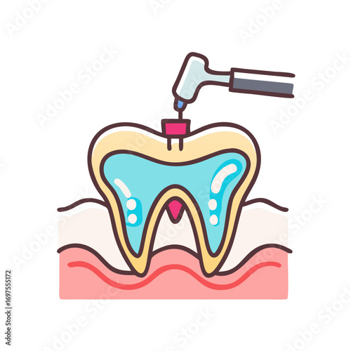 Dental Procedure Illustration Showing Tooth Cavity Filling Process