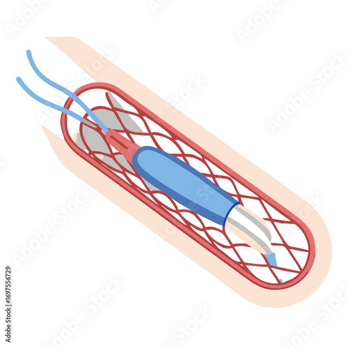 Artery stent placement medical illustration against black backdrop visual
