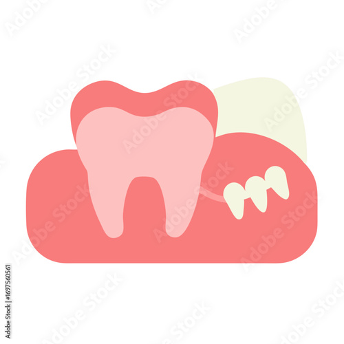 Impacted wisdom tooth anatomical illustration against a black background