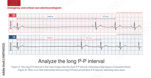 Quadro em tela Under normal circumstances, the anterior branch of the U wave of the electrocardiogram forms quickly, while the posterior branch forms slowly, so the shape of the U wave is asymmetric