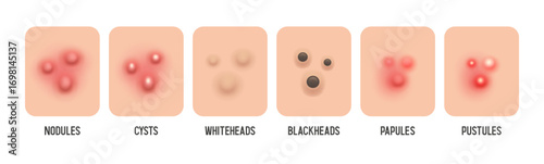 Acne. Types of acne. Papules, pustules, cysts, blackheads, etc. Vector illustration