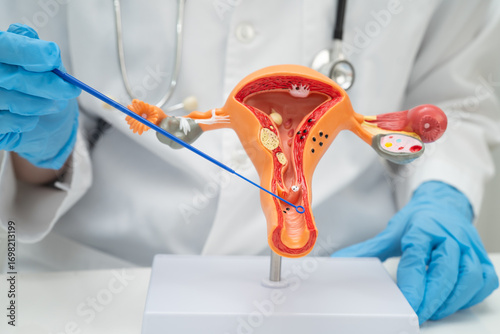 Doctor holding human uterus model for vaginal and cervix pap smear check up in the obstetrics and gynecology.