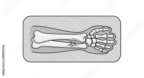 X-Ray Image of a Fractured Forearm and Hand.