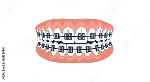 Teeth with Braces: Orthodontic Treatment for Alignment and Correction.