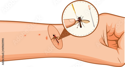mosquito bite and blood extraction from human arm on with eps