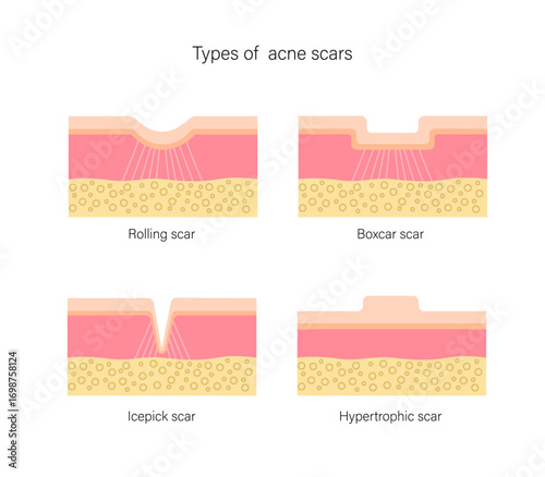 Set of acne scar types, atrophic and hypertrophic, rolling, boxcar, ice pick. Medical geometric flat illustration.