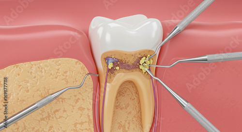 Dentist using instruments to clean plaque and tartar buildup from tooth root canal and surrounding bone
