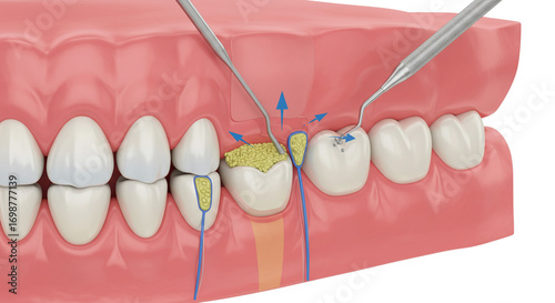 Detailed dental illustration shows plaque buildup and gum disease progression with surgical instruments cleaning teeth