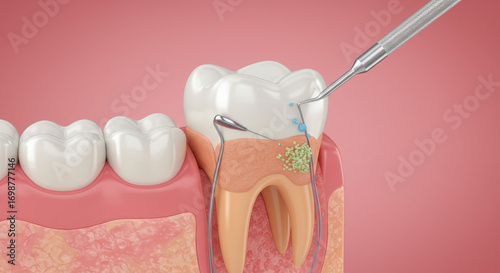 Professional dental cleaning procedure showing plaque removal from tooth root with specialized tools in a clear anatomical view