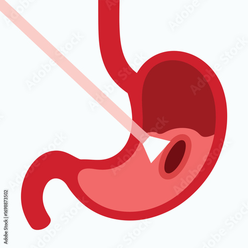 Medical illustration of a stomach with a visible ulcer and a beam of light