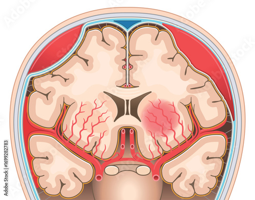 くも膜下出血・硬膜外血腫・硬膜下血腫・脳出血のイラスト
Illustrations of subarachnoid hemorrhage, epidural hematoma, subdural hematoma, and cerebral hemorrhage